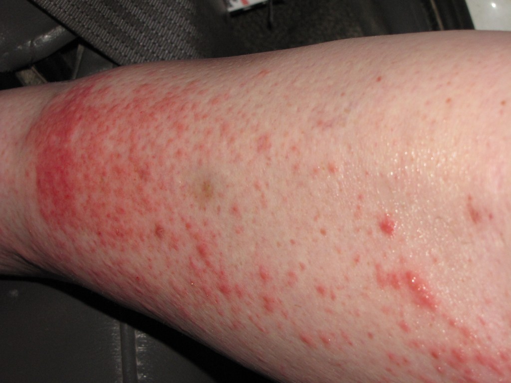 Docs leg right after the chigger bites